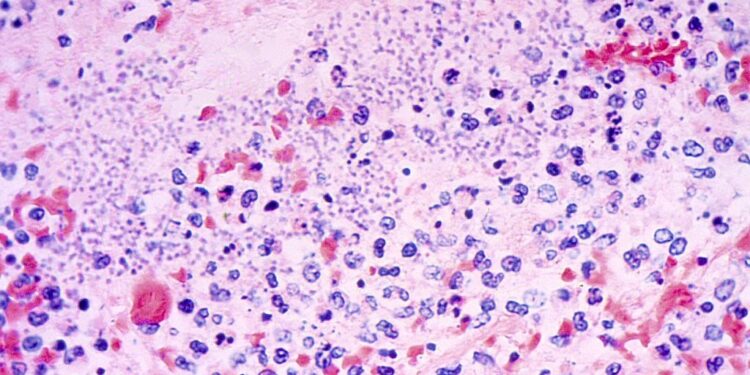 What to Know About Pneumonic Plague After Arizona Demise