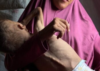 Gaza youngsters’s well being broken completely by malnutrition, medical doctors warn : NPR