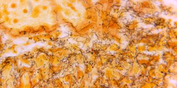 Why Syphilis Instances in Newborns Are Rising