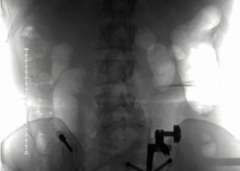 The Day My Backbone Shattered—and the Surgeon Who Rebuilt It
