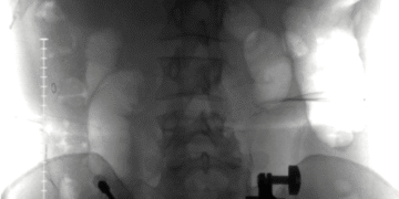 The Day My Backbone Shattered—and the Surgeon Who Rebuilt It