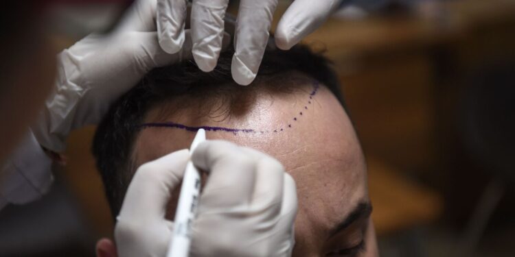 What makes this nation a high vacation spot for hair transplants : NPR