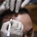What makes this nation a high vacation spot for hair transplants : NPR
